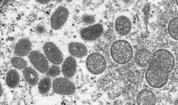 El número de personas contagiadas de gripe del mono en Chile supera los 200