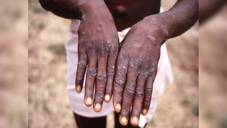 WHO likely to declare Mpox outbreak as a Global Emergency